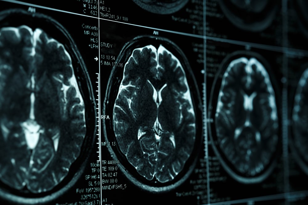 What is an Anoxic Brain Injury? Infant Brain Injuries Mithoff Law