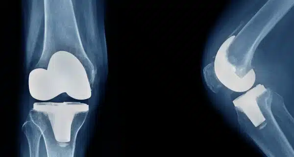 Knee replacement